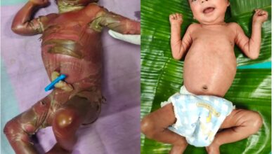 सुदूर बीजापुर में चिकित्सा चमत्कार : अत्यंत दुर्लभ बीमारी से जूझते शिशु को बचाया…. सुदूर बीजापुर में चिकित्सा चमत्कार : अत्यंत दुर्लभ बीमारी से जूझते शिशु को बचाया….