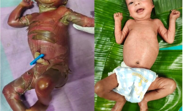 सुदूर बीजापुर में चिकित्सा चमत्कार : अत्यंत दुर्लभ बीमारी से जूझते शिशु को बचाया…. सुदूर बीजापुर में चिकित्सा चमत्कार : अत्यंत दुर्लभ बीमारी से जूझते शिशु को बचाया….